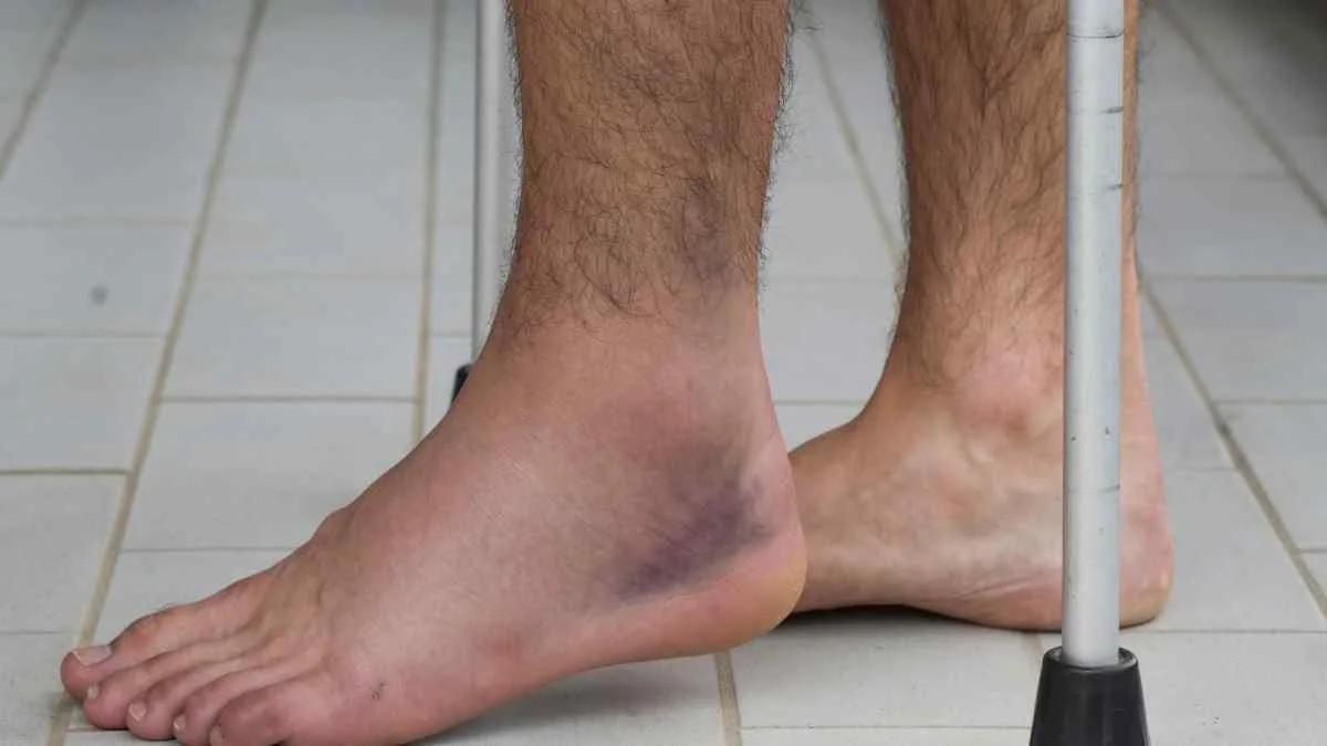 Como fazer um tornozelo torcido curar mais rápido