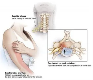 Prurido braquiorradial sintomas