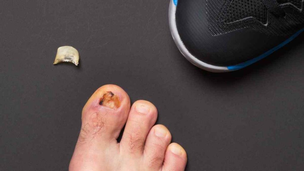 Como posso tratar o fungo de unha do dedo do pé?