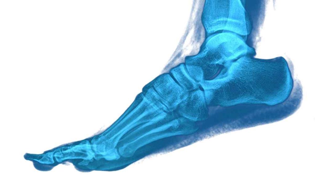 Remédios caseiros para artrite dos pés